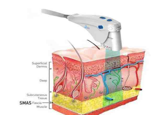Ulthera hifu. альтеря для ультрфзвукового лифтинга